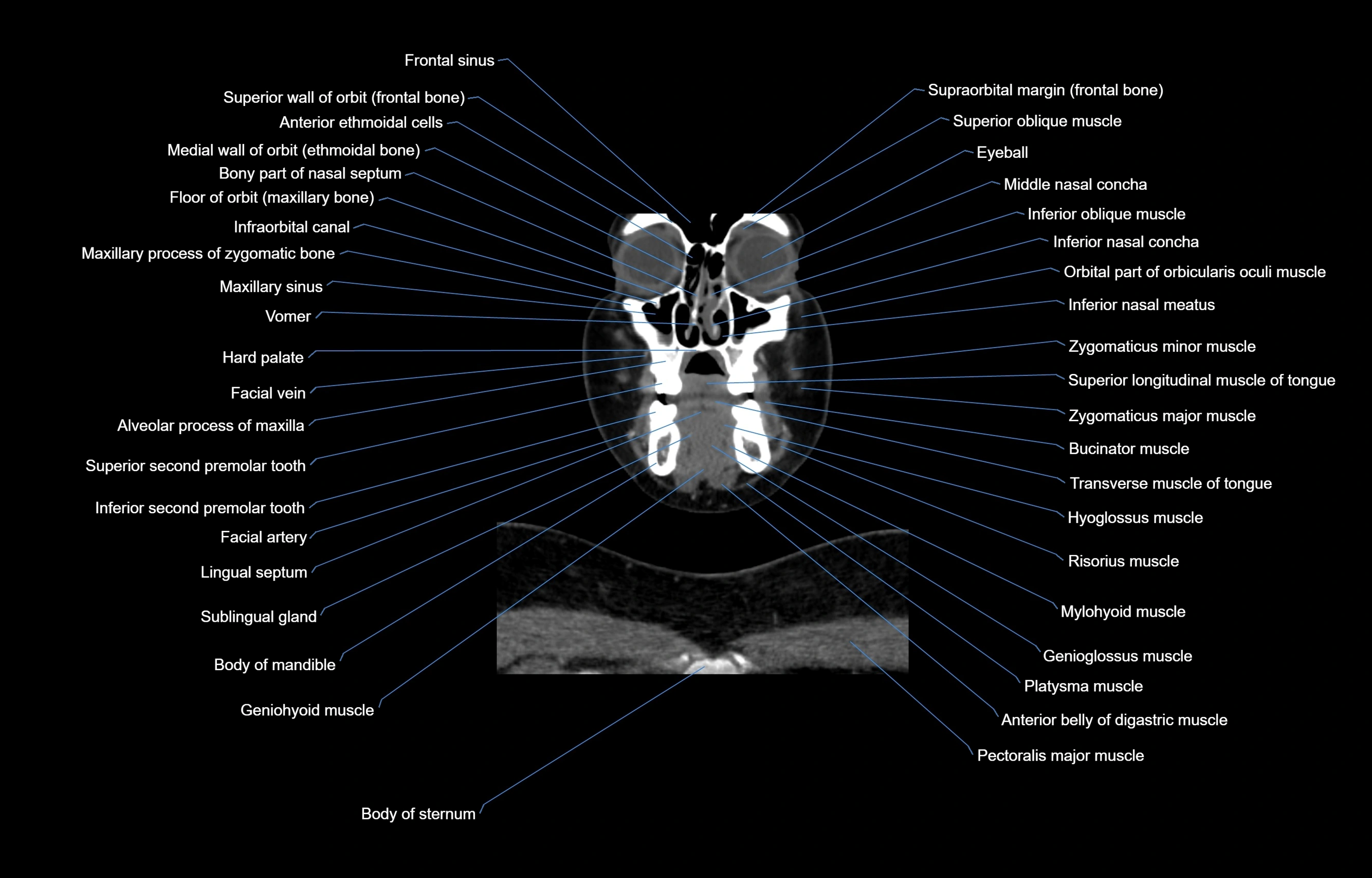 CT Neck coronal  cross sectional anatomy labelled 3D  radiology  image-00014.webp